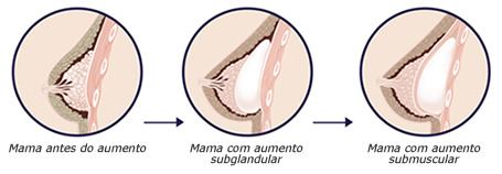 Implante mamario
