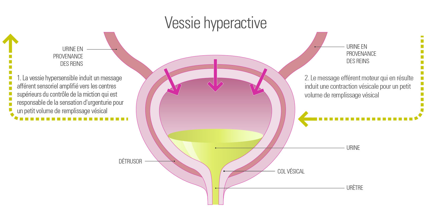 Schéma 3: Vessie Hyperactive